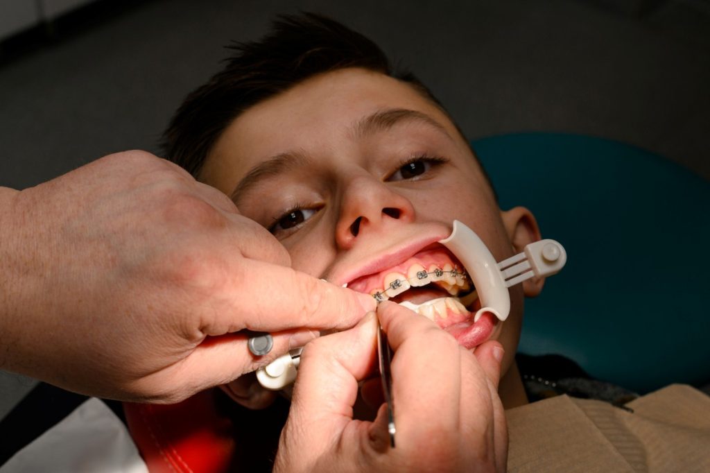 An orthodontist glues and fastens braces on the upper teeth of a young boy