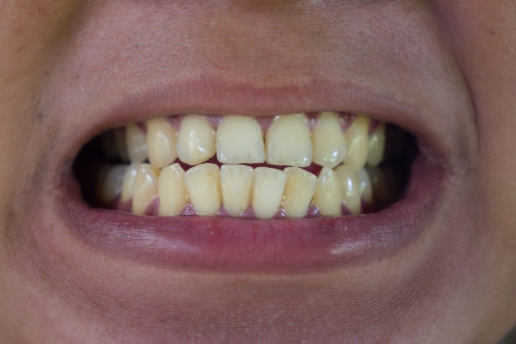close up shot of teeth with crossbite