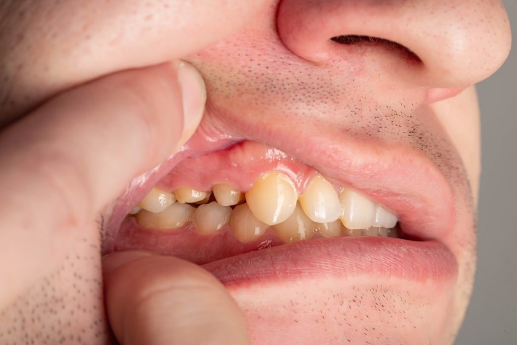 close up shot of man with overbite