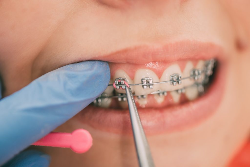 close up shot of mouth with braces being adjusted