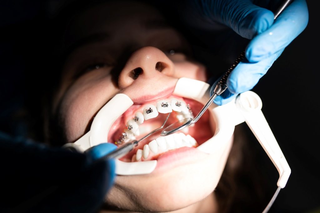 Close up of girl with brackets receiving dental braces treatment