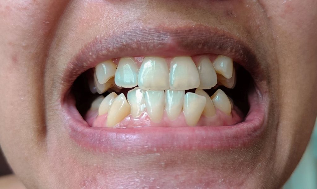 close up shot of a person's crooked teeth