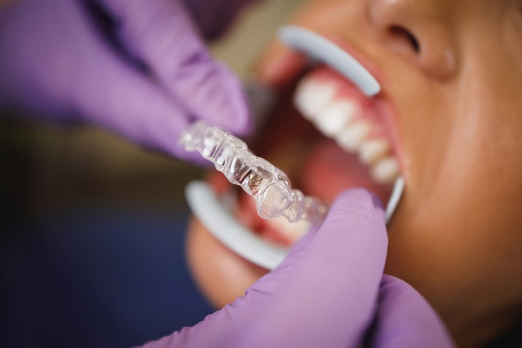 Invisalign Braces view