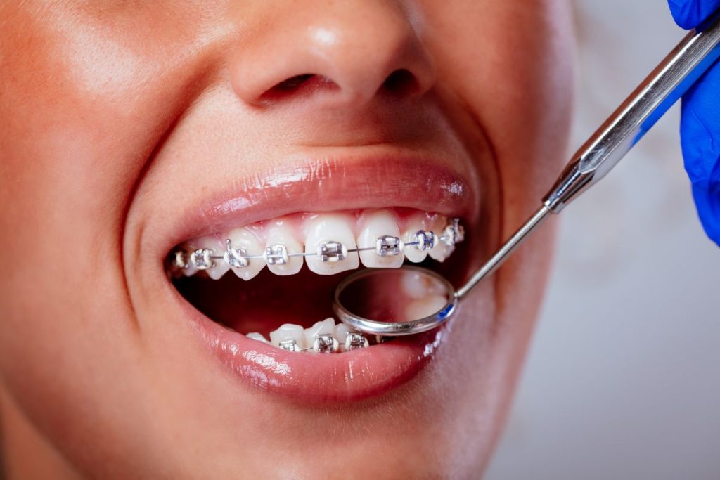 Checking Braces view
