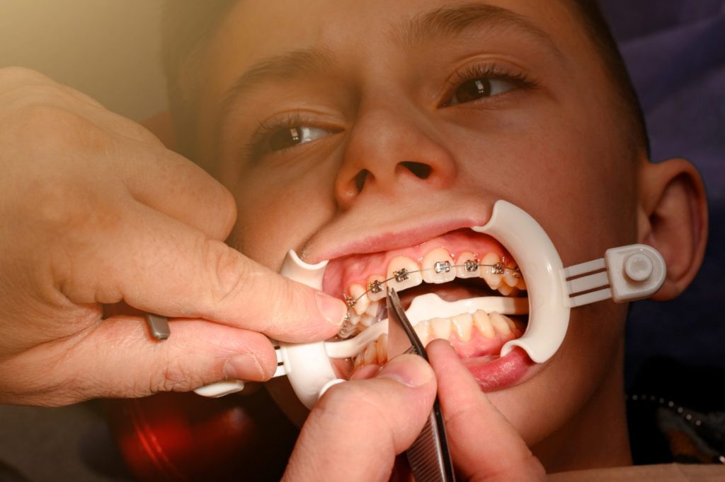 The teenager has braces glued to his upper teeth to straighten them, and the boy has a retractor on his lips