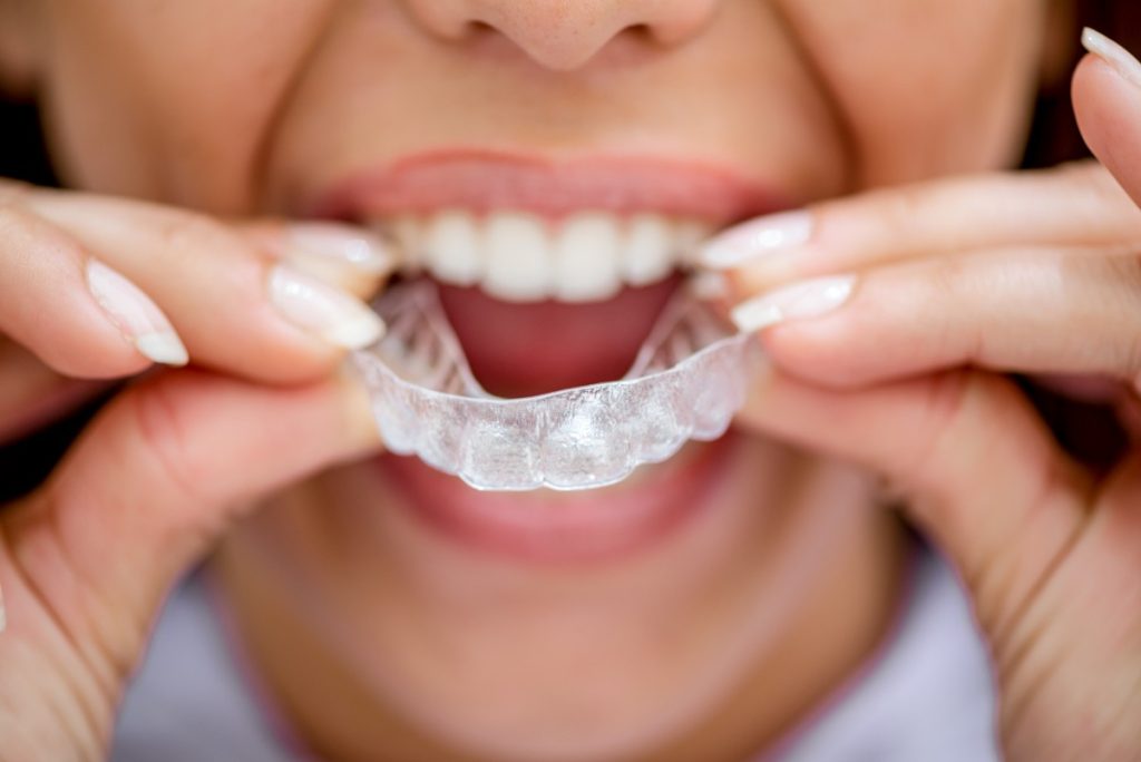 Invisible Braces view