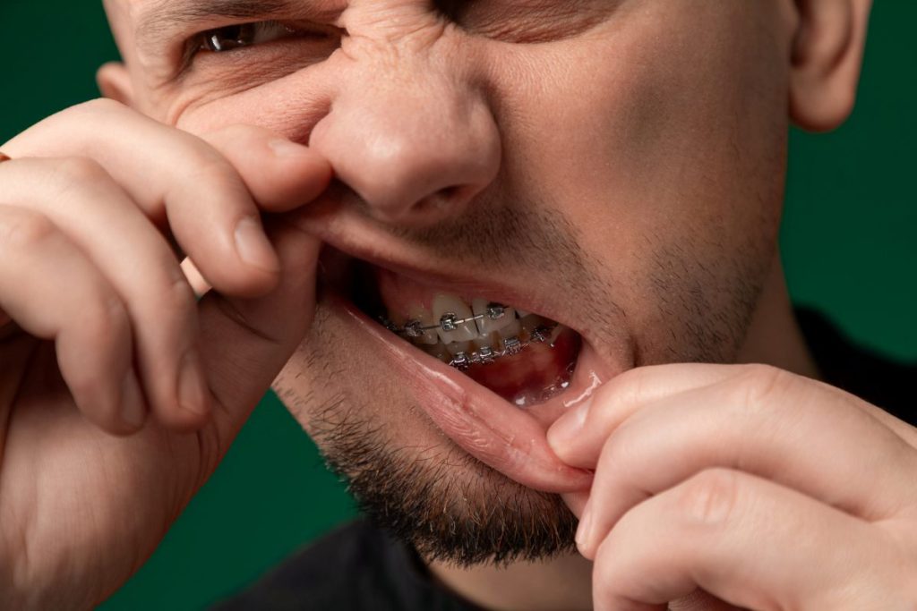 Man With Braces Holding Thumb to Mouth